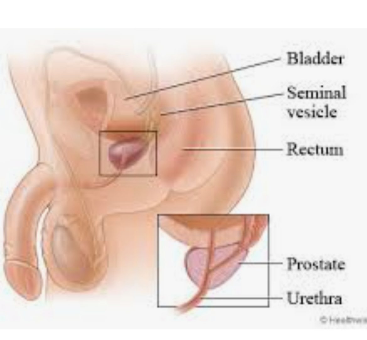 Prostate Cancer: sex, special diet not preventive factors- Urologist